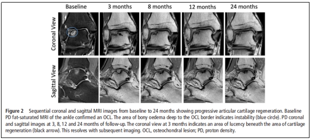 首次报道|干细胞治疗踝关节软骨损伤临床试验