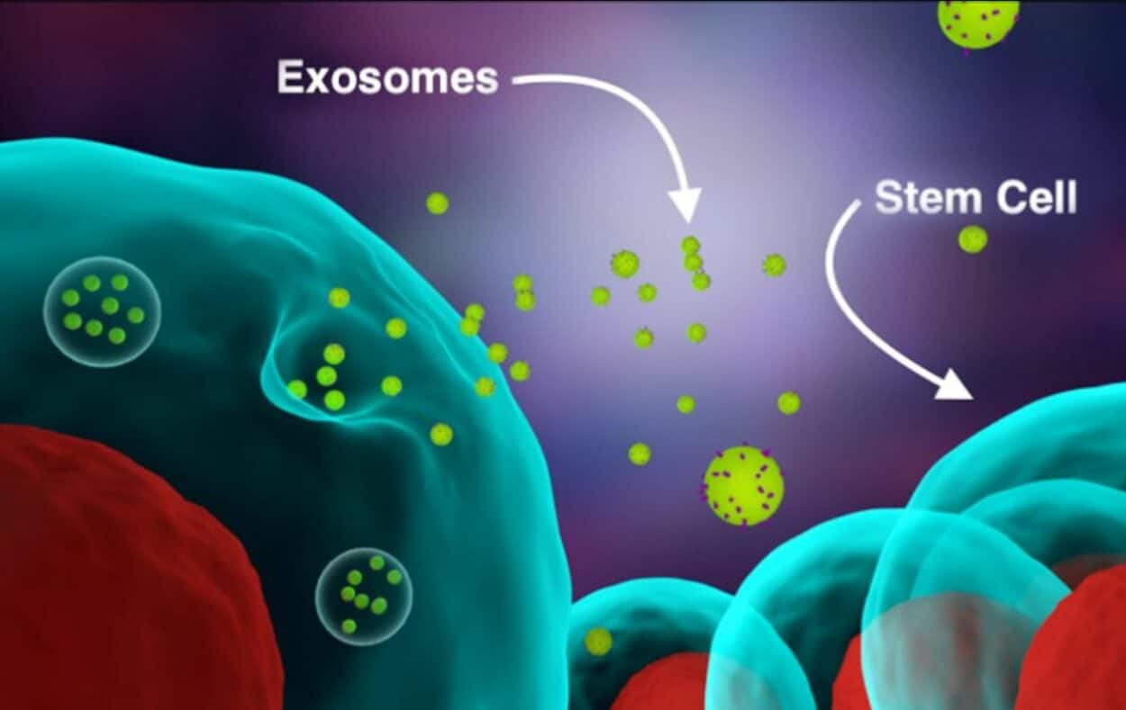 目标病变指数下降100%，病变厚度、红斑和硬结显著减少！银屑病患者接受高剂量外泌体治疗后病情显著改善！